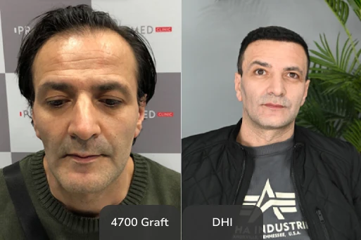 Before After 1