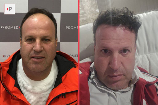 Before After 3