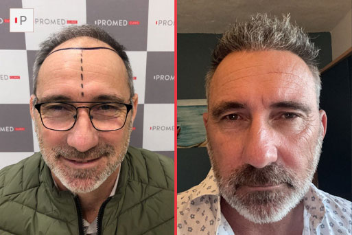 Before After 4