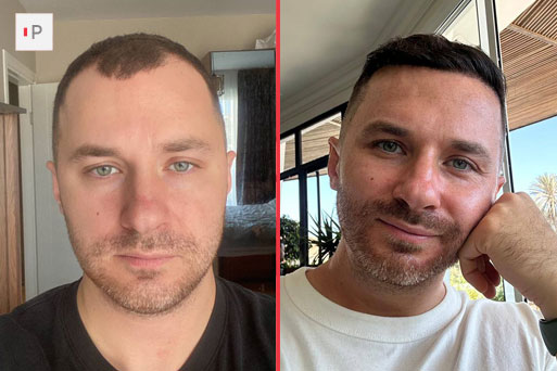 Before After 5