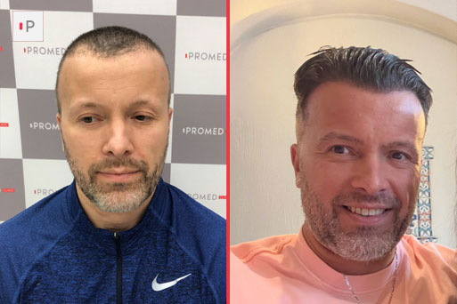 Before After 1