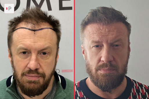 Before After 6