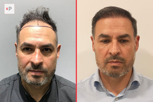 Before After 2
