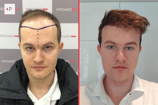 Before After 2