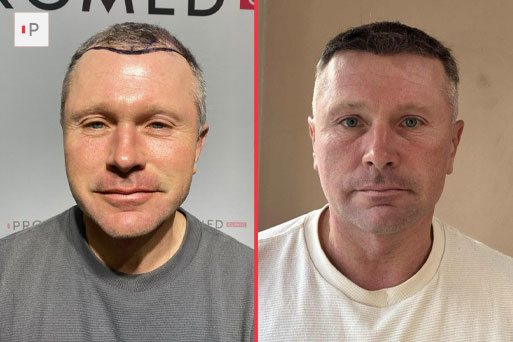 Before After 1