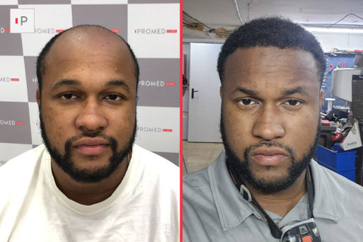 Before After 3