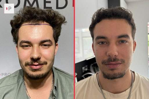 Before After 4