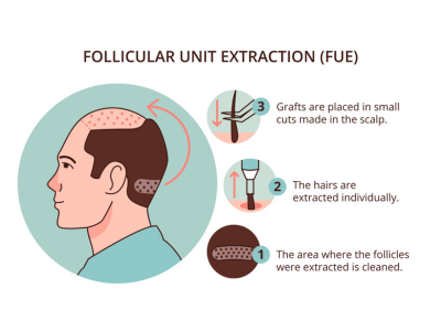 Wie wird eine FUE-Haartransplantation durchgeführt?